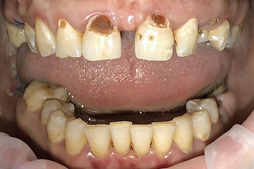 Художественная реставрация Estelite Asteria