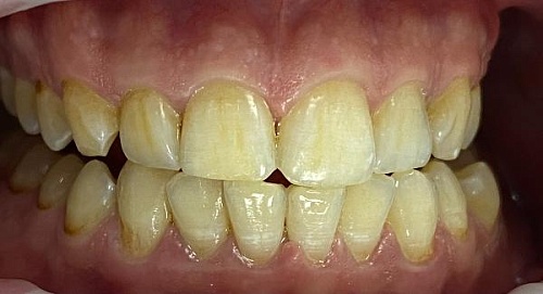 Отбеливание зубов Philips Zoom White Speed (Zoom4)