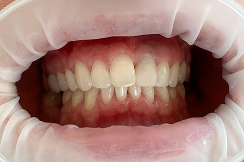 Отбеливание зубов системой Philips Zoom white speed