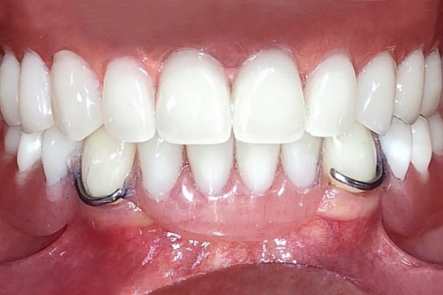 Установка протезов на обе челюсти