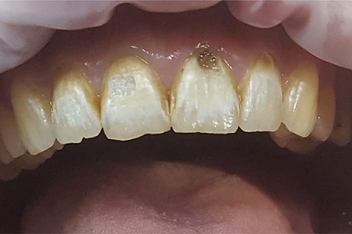 Лечение кариеса переднего зуба