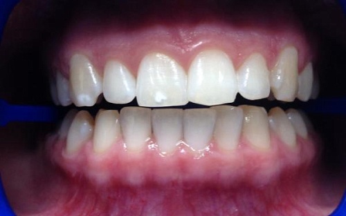 Клиническое отбеливание зубов Zoom White Speed