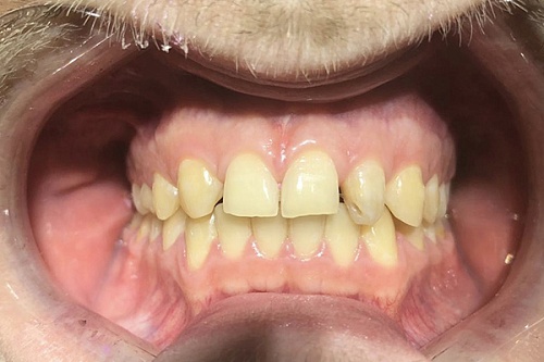 Исправление «линии улыбки» винирами E-max