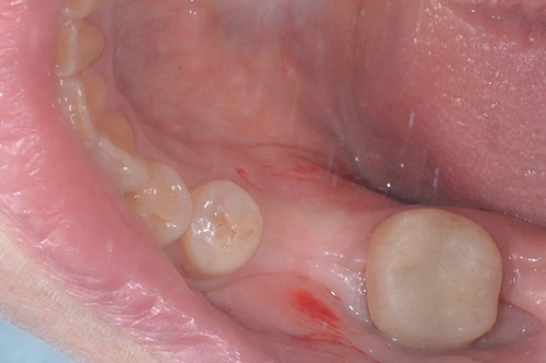 Имплантация Anyone