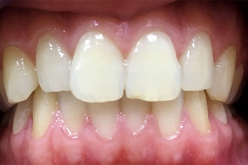 Исправление прикуса брекетами Damon