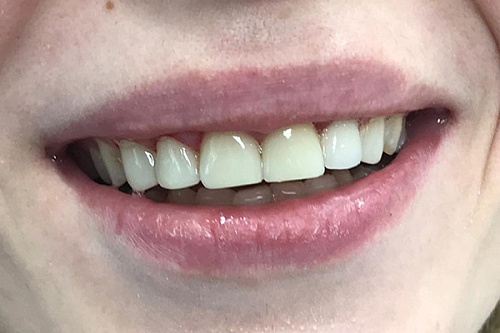 Установка безметалловых коронок