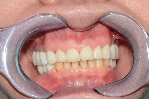 Протезирование коронками из диоксида циркония с использованием мостов