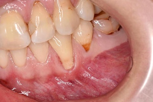 Лечение рецессии десен