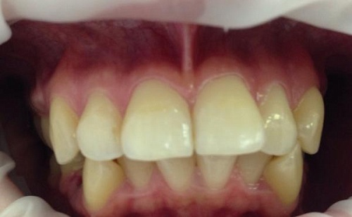 Выравнивание зубов комбинированными брекетами Damon