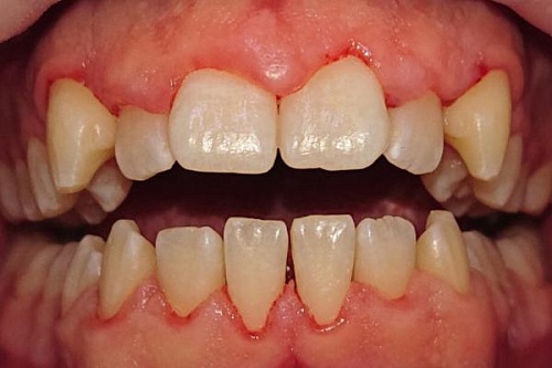 Профессиональная гигиена ультразвуком и Air Flow