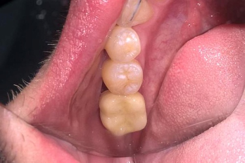 Установка коронки на имплант из диоксида циркония