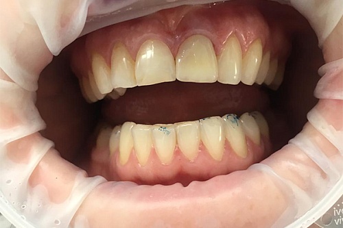 Установка одиночной коронки на зуб