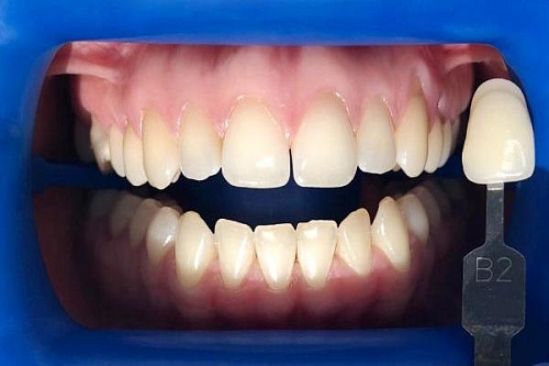 Отбеливание зубов системой Philips Zoom 4