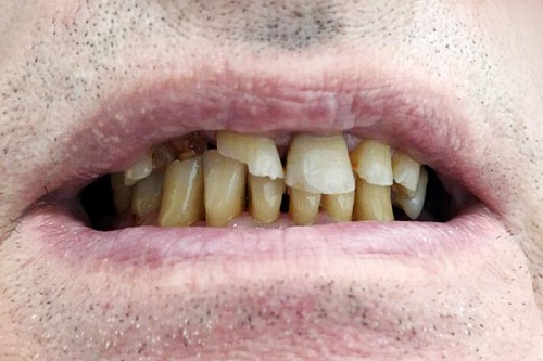 Установка безметалловых керамических коронок