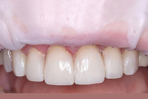 Художественная реставрация фронтальных зубов