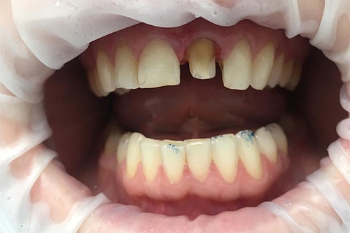 Установка одиночной коронки на зуб