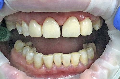 Художественная реставрация Estelite Asteria