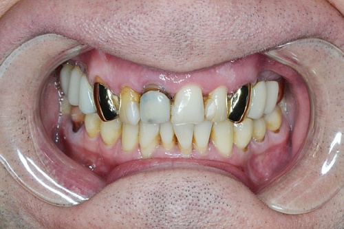 Протезирование с помощью циркониевых коронок с керамическим покрытием