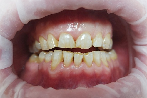 Отбеливание зубов Philips Zoom White Speed