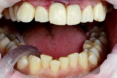 Лечение кариеса и художественная реставрация зубов