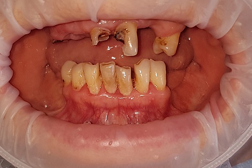 Восстановление верхнего ряда протезированием All-on-4