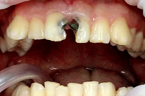 Лечение кариеса и художественная реставрация зубов