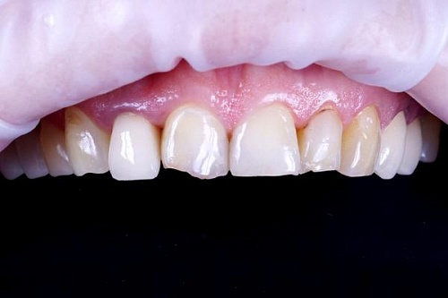 Изготовление и установка виниров E-max на верхнюю челюсть