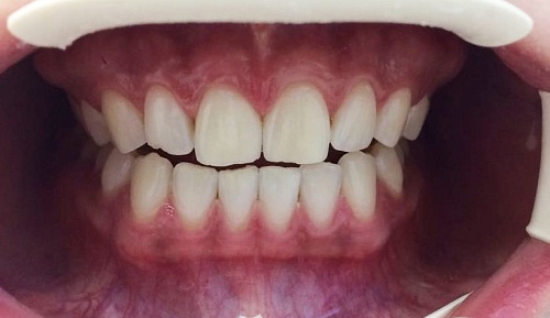 Отбеливание ZOOM 4