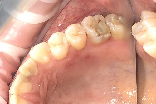 Лечение вторичного кариеса