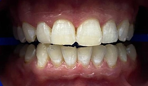 Отбеливание зубов Philips Zoom White Speed (Zoom4)