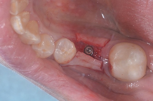 Имплантация Anyone