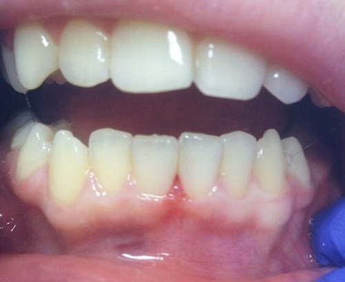 Установка пломб Эстелайт при лечении кариеса у ребенка