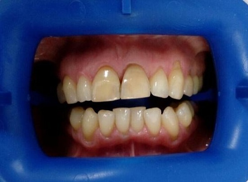 Клиническое отбеливание зубов Zoom White Speed