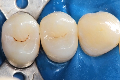 Лечение скрытого кариеса