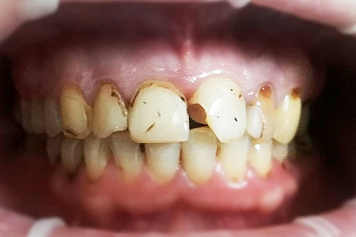 Установка композитных виниров в зоне улыбки