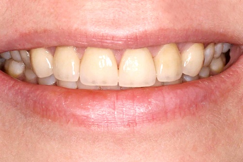 Устранение трем и диастем при помощи виниров E-max