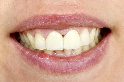 Установка керамических виниров