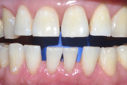 Инновационная система отбеливания ZOOM 3