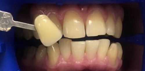 Отбеливание зубов офисной системой Zoom 4