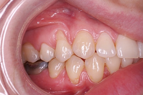 Закрытие рецессии четырнадцатого зуба