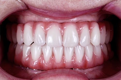 Протезирование All-on-4, верхняя и нижняя челюсти