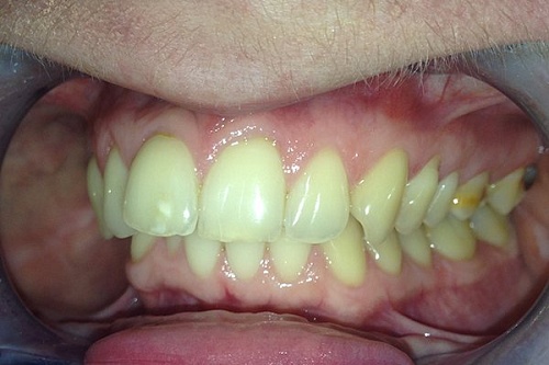 Выравнивание центральных резцов