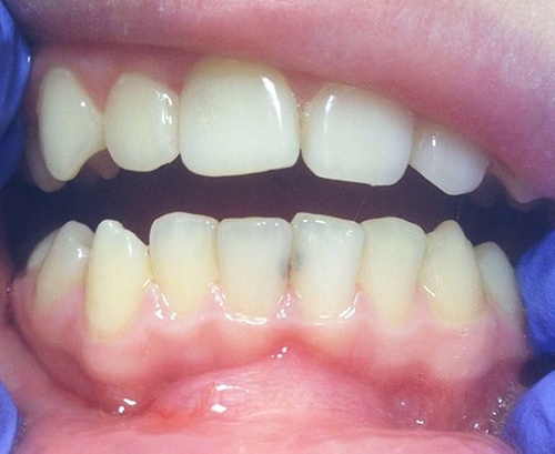 Установка пломб Эстелайт при лечении кариеса у ребенка