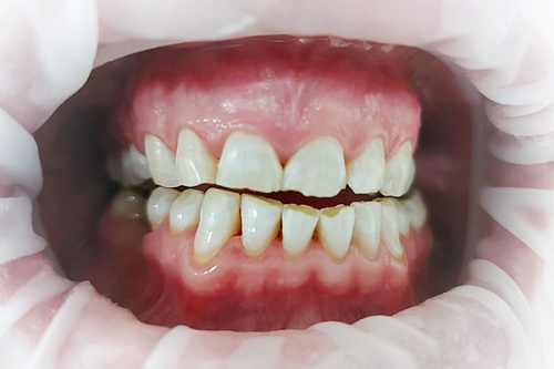 Отбеливание зубов Philips Zoom White Speed