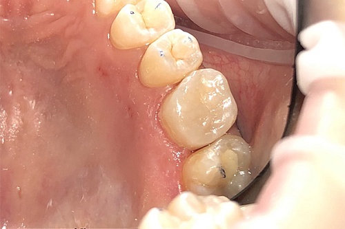 Лечение вторичного кариеса