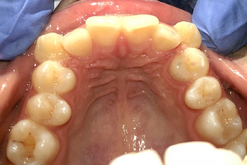 Исправление прикуса брекетами Damon