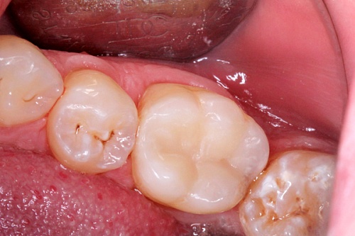 Лечение кариеса материалом Estelite Sigma Quick