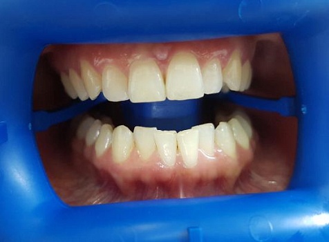 Удаление пигментации на зубах системой Zoom 4