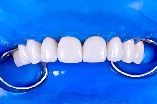 Изготовление и установка виниров E-max на верхнюю челюсть