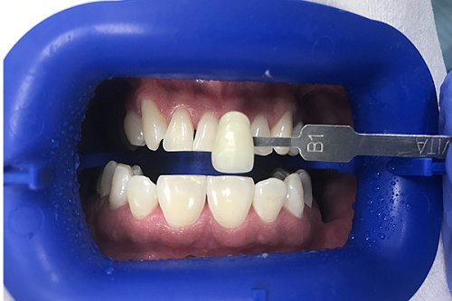 Отбеливание зубов Zoom White Speed